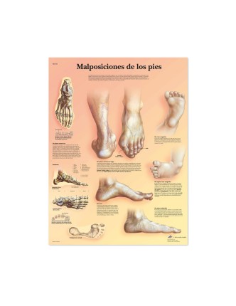 Lámina Anatómica malposiciones de los pies ( 50 x 67 cm.)
