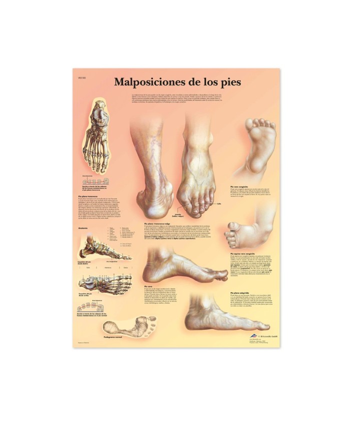 Lámina Anatómica malposiciones de los pies ( 50 x 67 cm.)