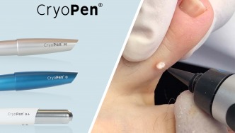 La nueva dimensión en crioterapia en un pequeño instrumento de criocirugía muy potente y de fácil uso